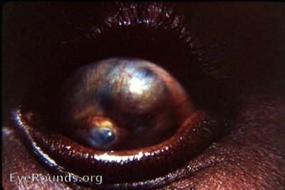 Ciliary staphyloma with descemetocele