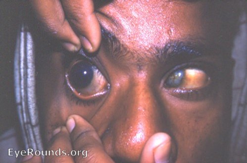 hydrophthalmos OU with leukomatous cornea OS