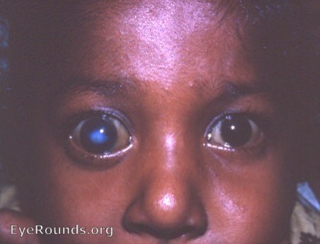 hydrophthalmos OU with leukomatous cornea OS