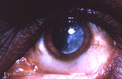 intracapsular cataract extraction that failed-ending up as an extracapsular extraction with retention of significant lens material