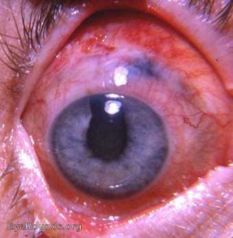 iridencleisis with peripheral iridectomy - a modified iridotasis operation for open- angle glaucoma