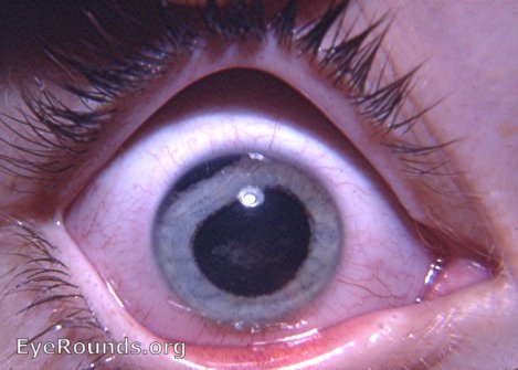 traumatic cataract with iridodialysis