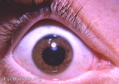 traumatic cataract with iridodialysis