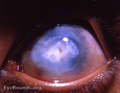 cornea: macular corneal scar - a residual of a noe inactive keratitis