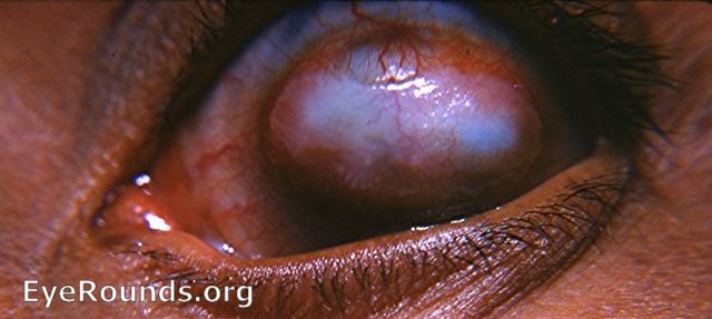 vascularized staphlyoma of the cornea - the result of a smallpox attack
