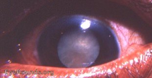 Cataract: Is my cataract ready for surgery?