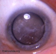 Cataract: Is my cataract ready for surgery?