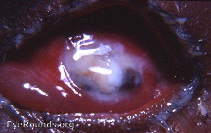 the ultimate post-op ocular complication of cataract surgery