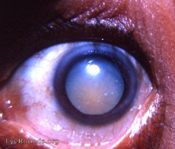 pre-Morgagnian cataract