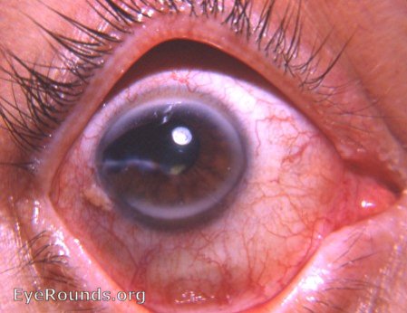 scissors perforation of cornea, adherent leucoma,