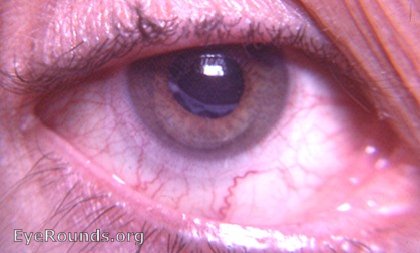 true-exfoliation of the anterior capsule of the lens - evident after intracapsular cataract surgery