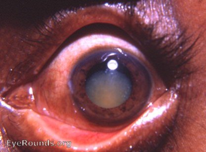 Morgagnian hypermature cataract:: a rare shrinking stage