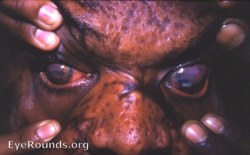 smallpox: marked staphyloma of cornea OU 1962