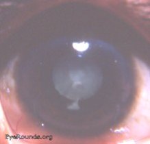 zonular/ lamellar cataract in India: computer enhanced