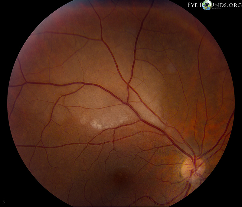 Retinal vascular occlusion