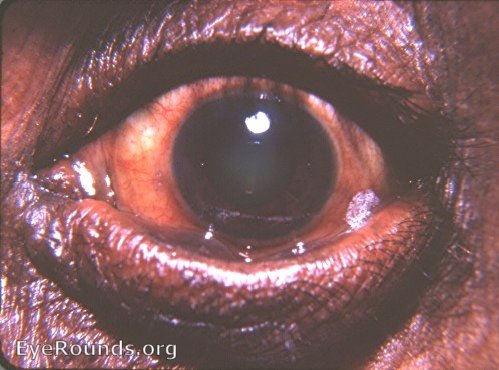 Vitamin A deficiency: Temporal Bitot's spot, slight ectropion lower lid, tylosis, and nuclear cataract