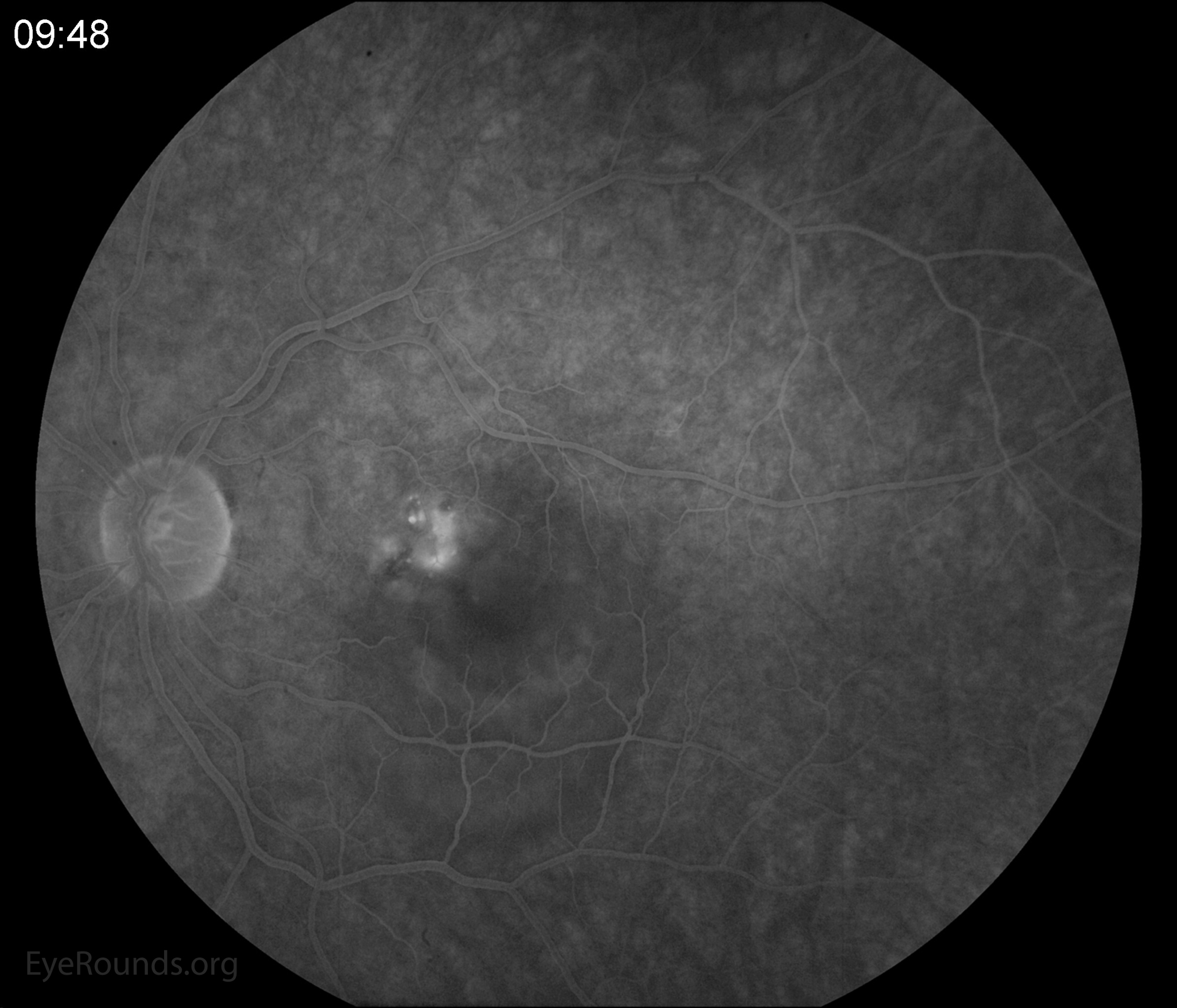 There are multiple leakage points including the fovea on fluorescein angiography. In the late phase, one can see the classic "smokestack" leakage of dye 9 minutes and 48 seconds
