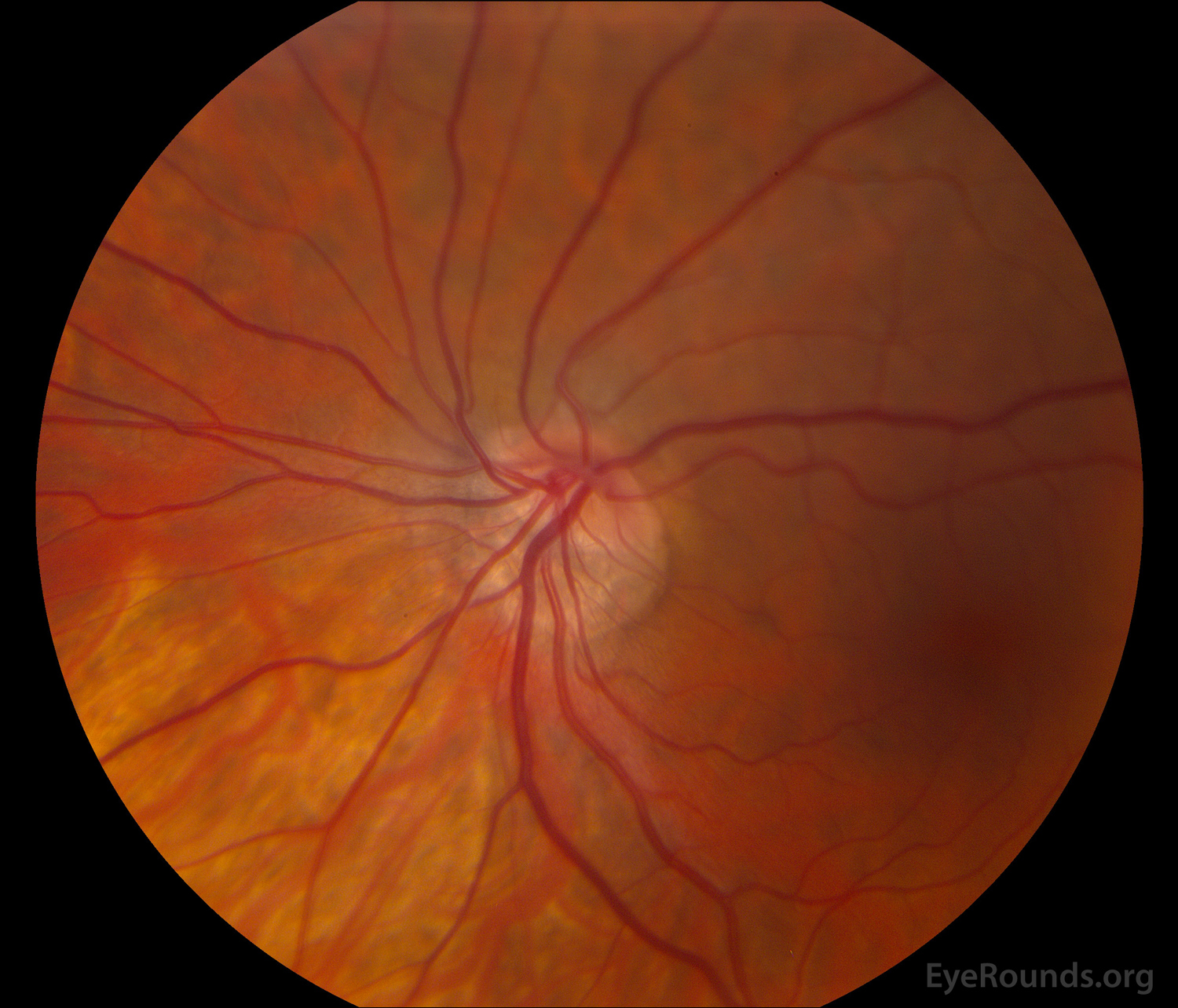 congenital-tilting-of-the-optic-nerve-with-situs-inversus