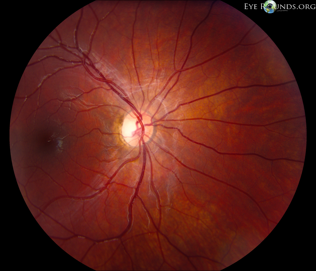 An 18-year-old man with dominant optic atrophy (DOA). The fundus