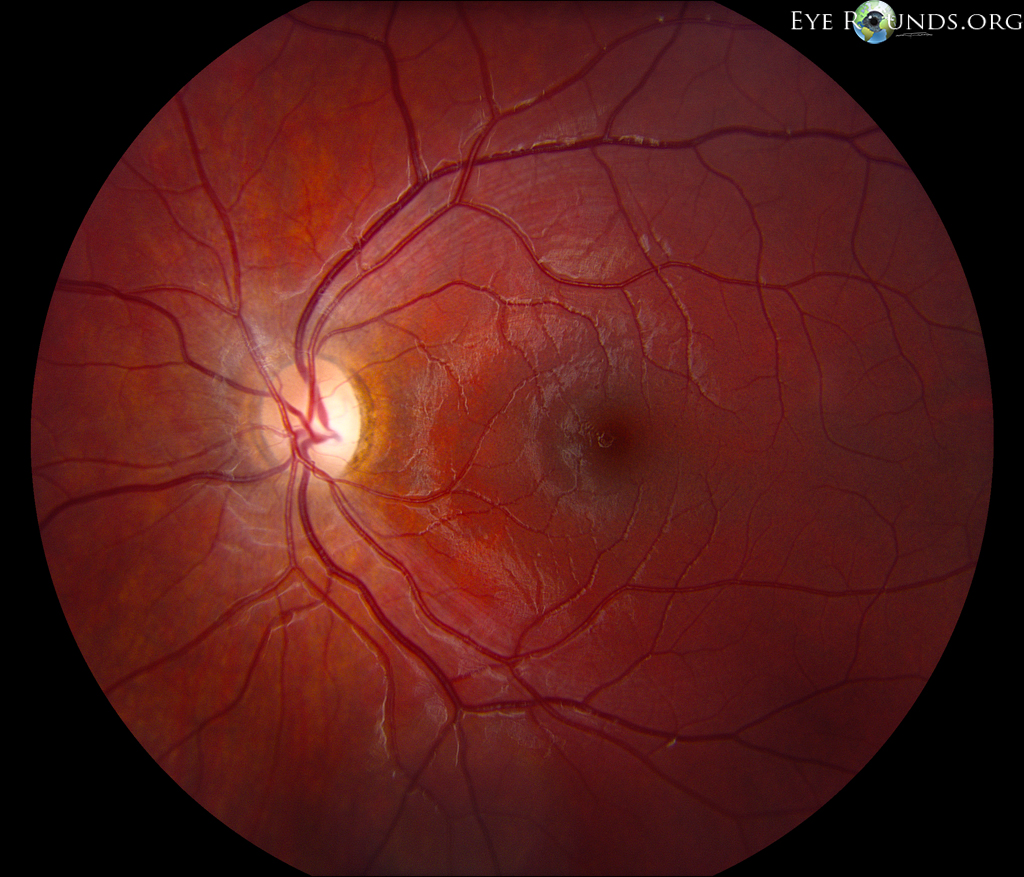 dominant-optic-atrophy