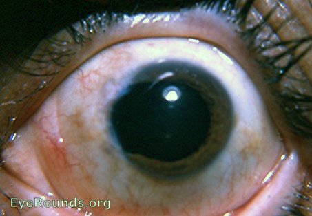 post excision of huge prolapsed iris following intracapsualr cataract surgery with 180 degree incision superiorly