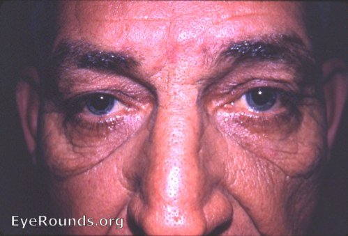 Groenblad-Stranberg syndrome- pseudoxanthoma elastcum with andioid streaks of the fundus oculi