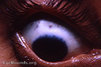 classic Herbert's pits in trachoma
