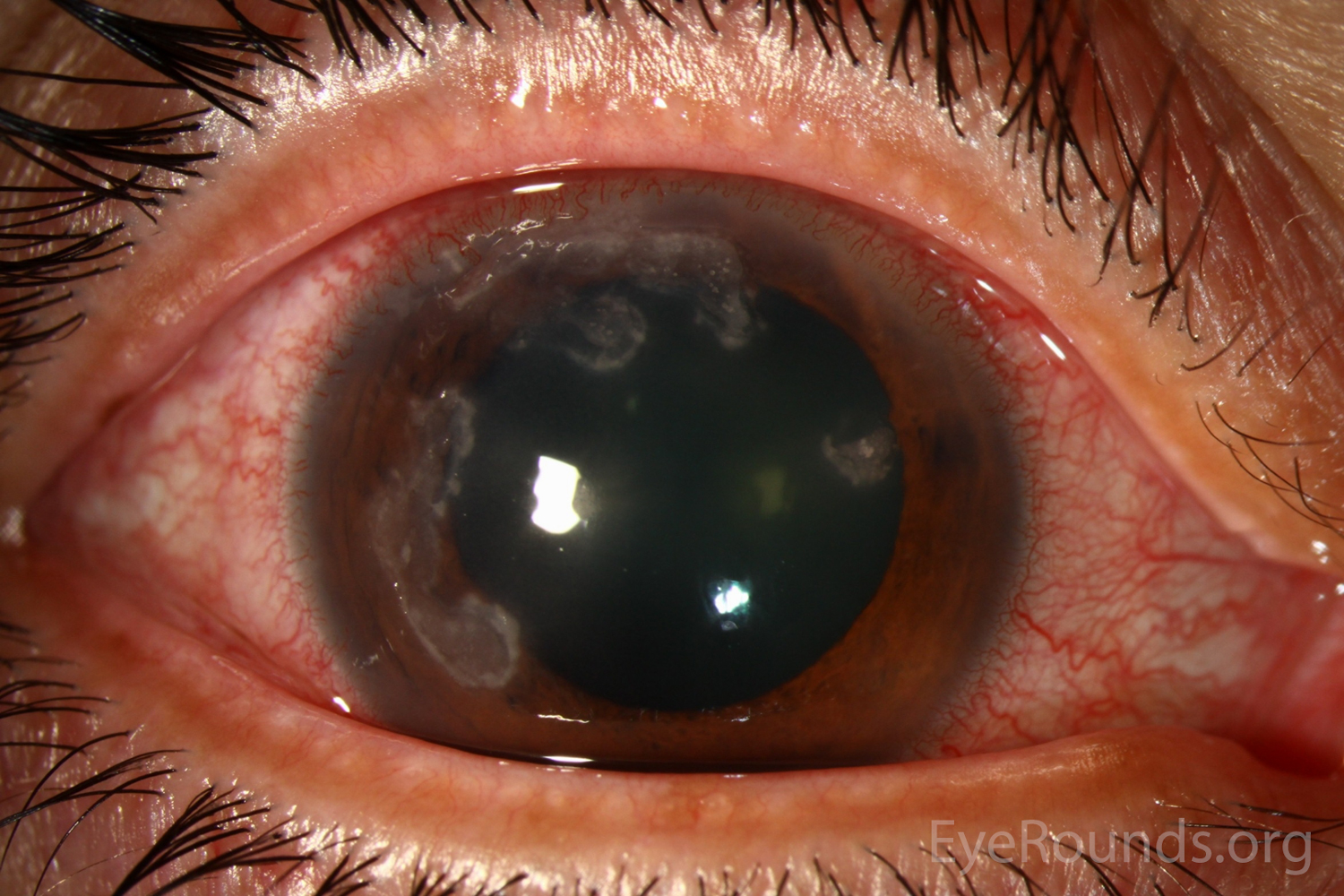 Nocardia Farcinica Keratitis In A Contact Lens Wearer