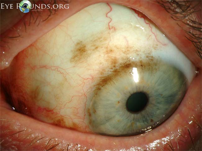 Melanoma of the Eye - Symptoms, Causes, and Treatment