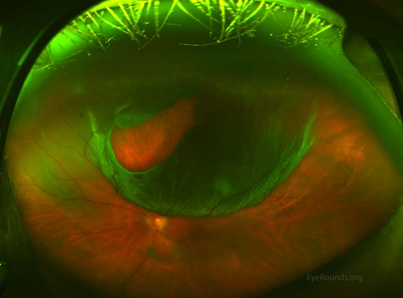 with an inferior visual field defect and multiple flashes and floaters 