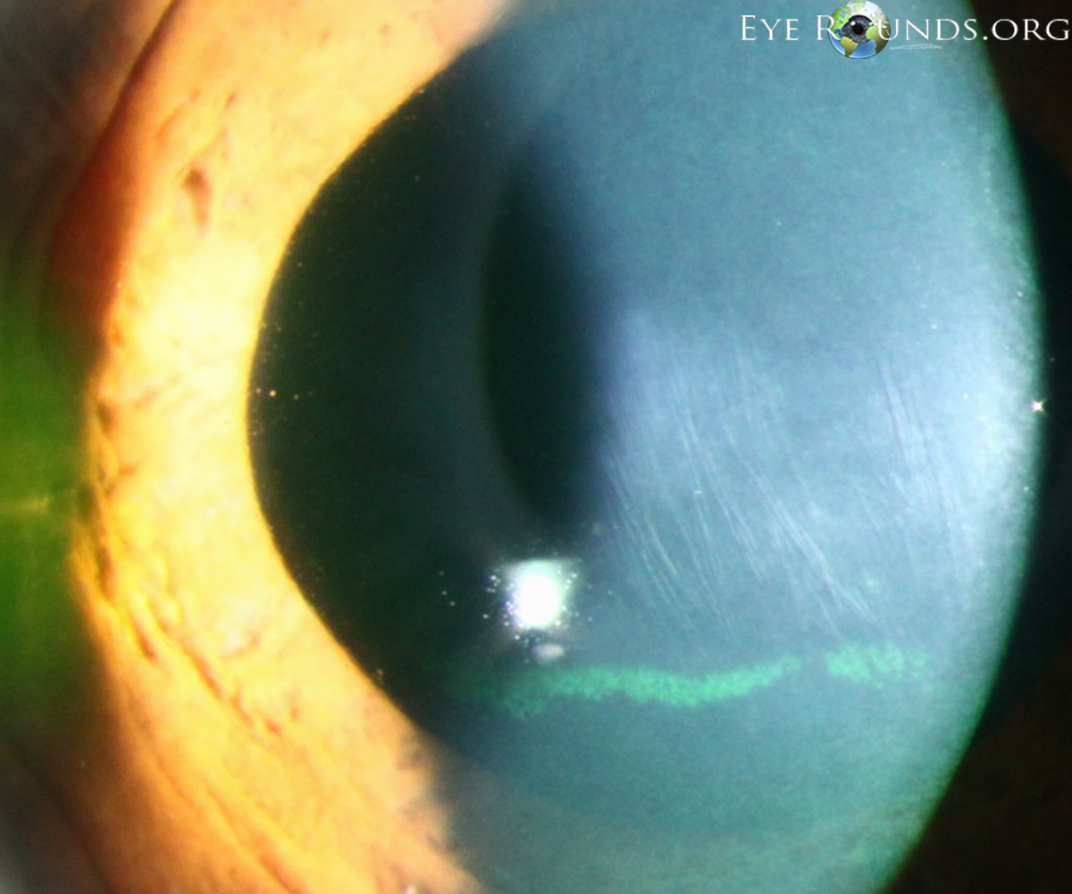 external photo showing Vogt's striae are vertical (rarely horizontal) fine, whitish lines in the deep/posterior stroma and Descemet's membrane commonly found in patients with keratoconus slit lamp close-up