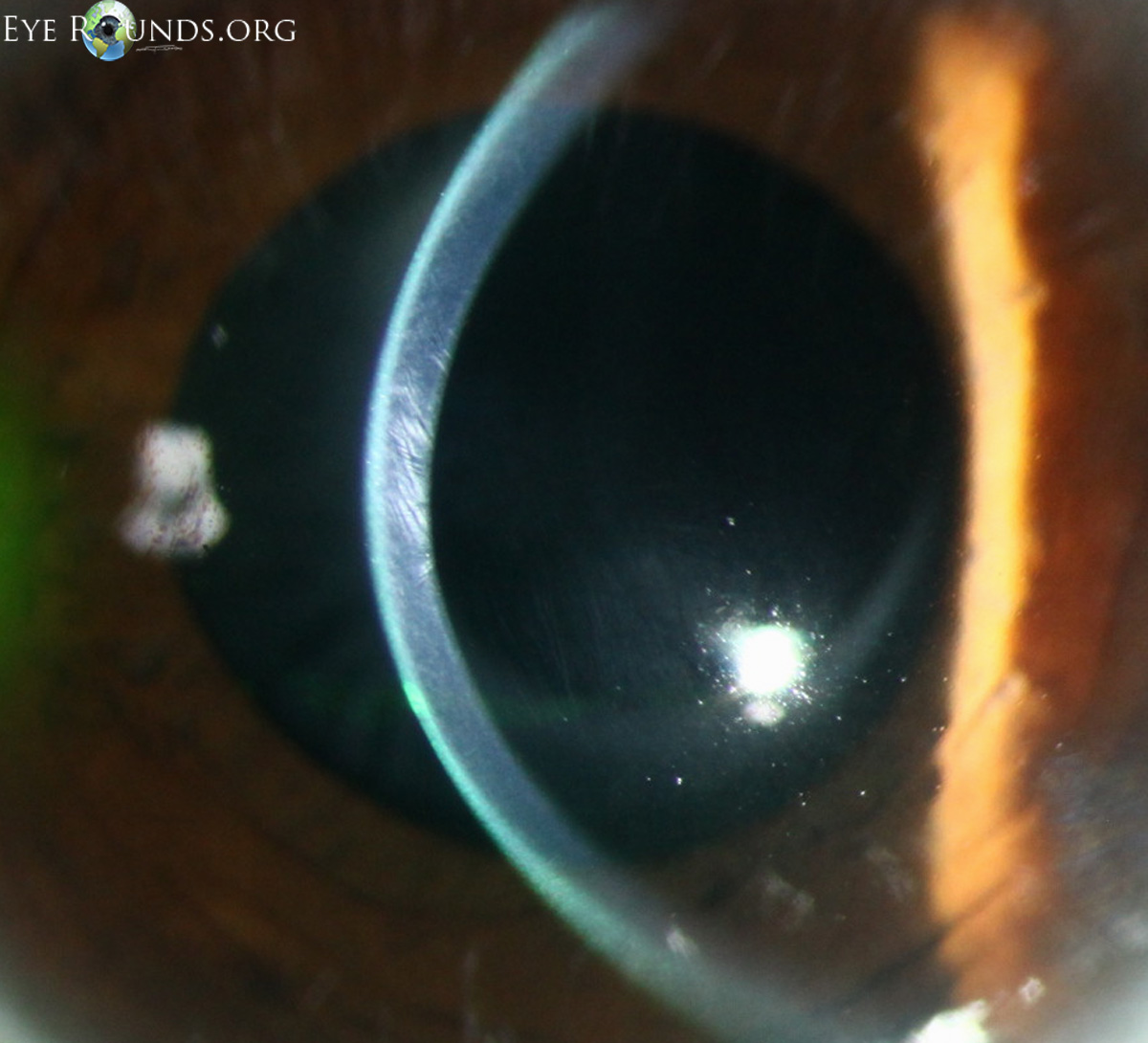 external photo showing Vogt's striae are vertical (rarely horizontal) fine, whitish lines in the deep/posterior stroma and Descemet's membrane commonly found in patients with keratoconus slit lamp close-up straight on view