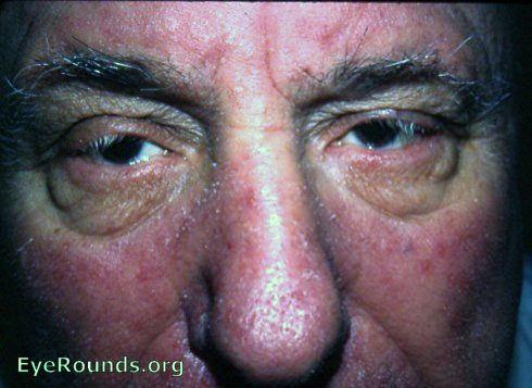 Acne Rosacea Images. Rosacea (formerly acne rosacea