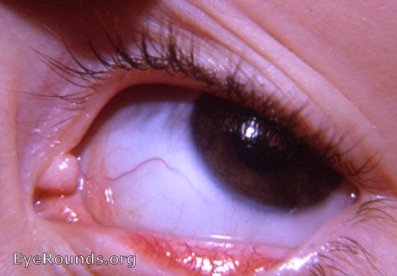 congenital anomaly of caruncula lacrimalis