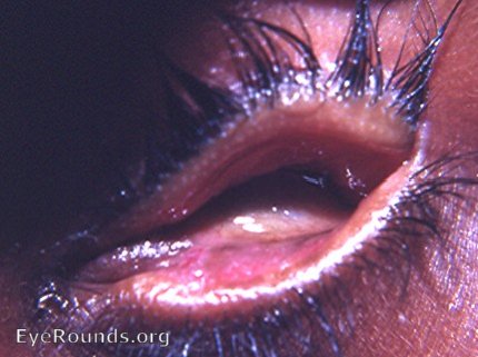 clinical congenital anophthalmos