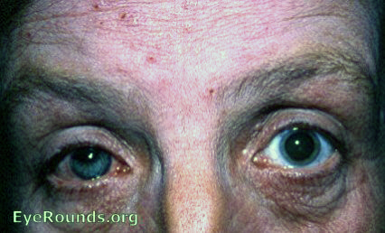 atopic dermatis with cataracta complicata