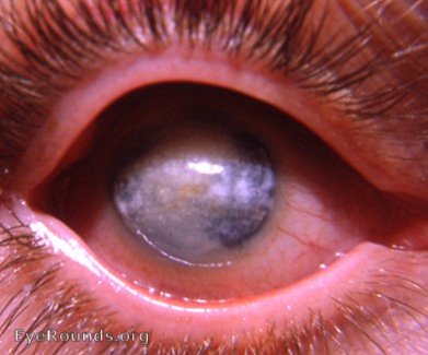 atrophia bulbi with leukomatous cornea that is showing fatty and calcium infiltration.