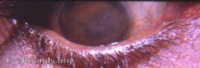 bloodstaining of the cornea
