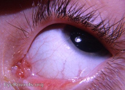 congenital anomaly of caruncula lacrimalis