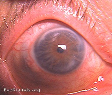 ciliary staphyloma/ectasia iris atrophy on transillumunation 360degrees and arcus senilis superiorly