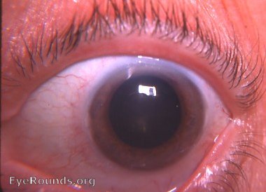 miotic pupil size