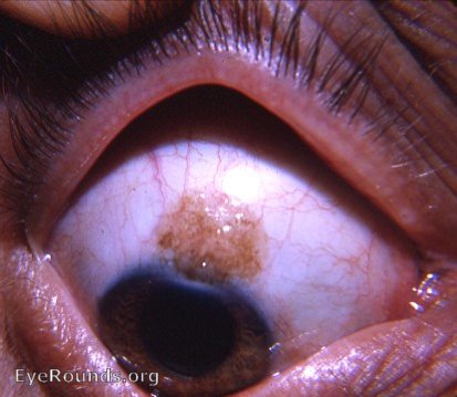 cystic pigmented nevus of the bulbar conjunctiva in the palpebral fissure zone