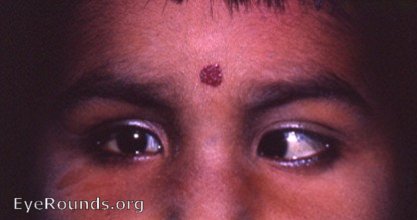 esotropia OS with bilateral coloboma of the iris