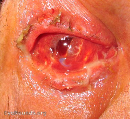 exposed orbital implant in anophthalmic socket