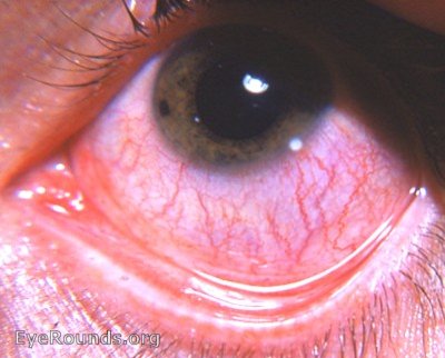 corneal foreign bodies