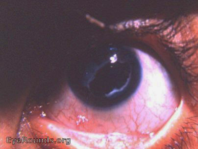 Extracapsular cataract in a child: the use of the Fuchs' syringe
