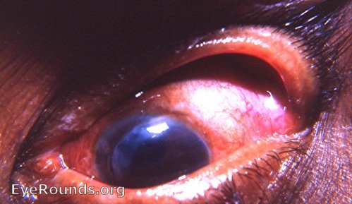 The von Graefe incision in cataract surgery - an historical note