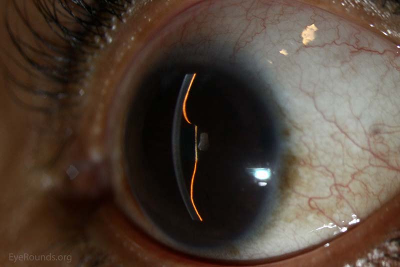 uveitis: chronic anterior uveitis with cataracta complicata, posterior synechiae with seclusio pupillae and iris bombe'