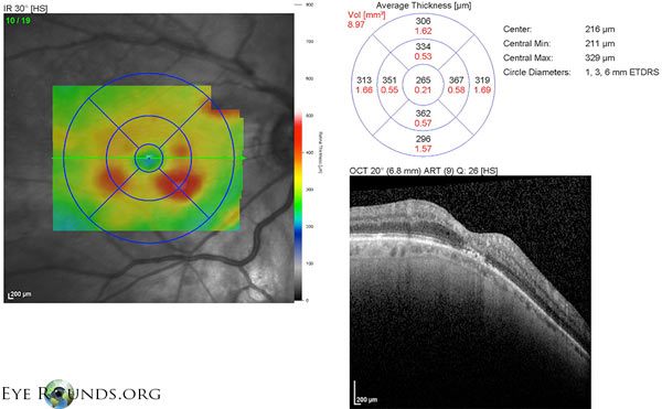 OCT OD: irregularities of outer retinal layer in the fovea with scant patchy areas of inner retinal edema and opacifications