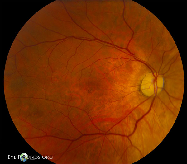  fundus after chemotherapy, and her follow-up fundus photos are shown below 3